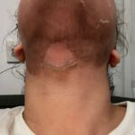 TCA 35% 4e dag