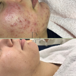 voor na acne